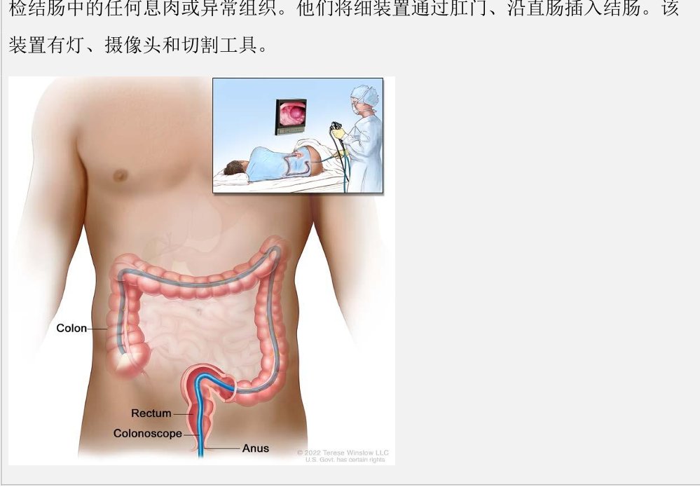 NCCN 患者指南结肠癌示意图